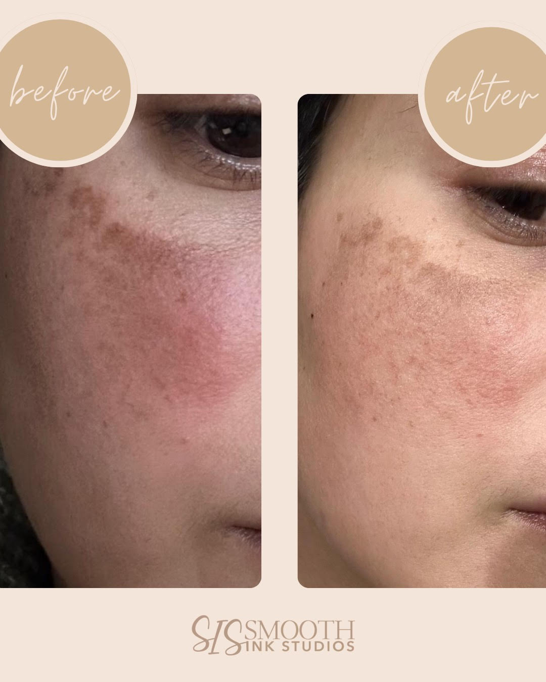Scar Powder